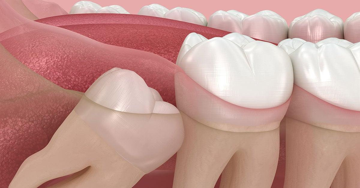 Could You Use Some "Wisdom" About Your Wisdom Teeth?